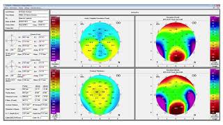 OCULUS Pentacam® AXL Demo at AAO 2017 screenshot 5