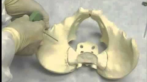 Vídeo do procedimento BMAC (Bone Marrow Aspiration Concentrate)