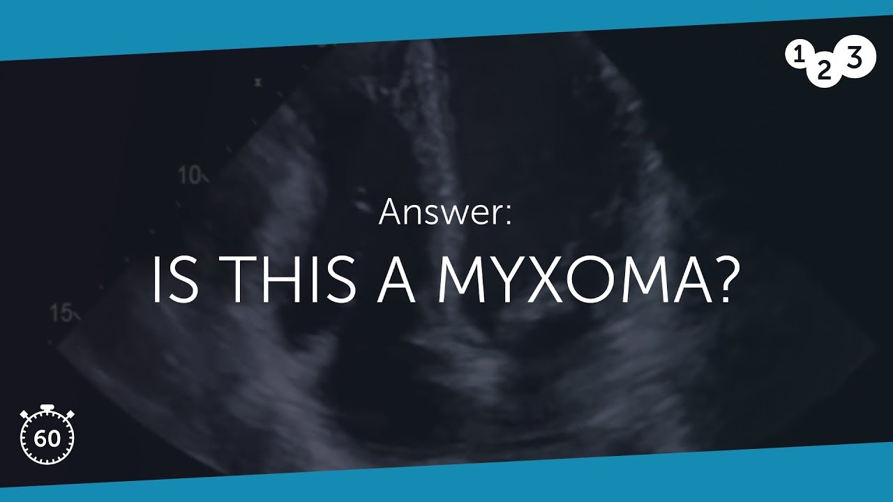60 Seconds of Echo Teaching Answer: Is this a myxoma?