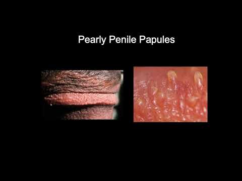 Doctor explains PEARLY PENILE PAPULES - small lumps on the head of the penis...