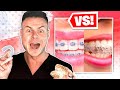 BRACES VS INVISALIGN Which IS Best For You?! The Answer Will SURPRISE You!