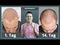 Die ersten 1 - 14 Tage nach Haartransplantation [Heilungsverlauf]