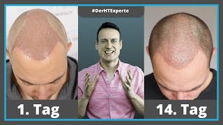 Die ersten 1 - 14 Tage nach Haartransplantation [Heilungsverlauf]