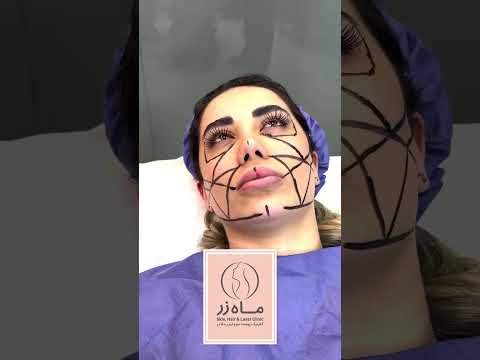 تزریق چربی به صورت کلینیک زیبایی ماه زر