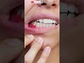 درمان اورژانسی عفونت و تورم لثه و دندان درد دمان عفونت لثه Shorts سلامتی با ماساژ درمان دندان 