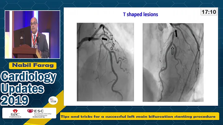Tips and Tricks in LM PCI   Prof  Nabil Farag