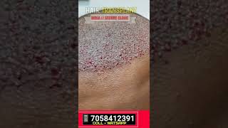 Dead Skin Clear After 10 days Hair Transplant Result #hair #shortvideo #hairstyle