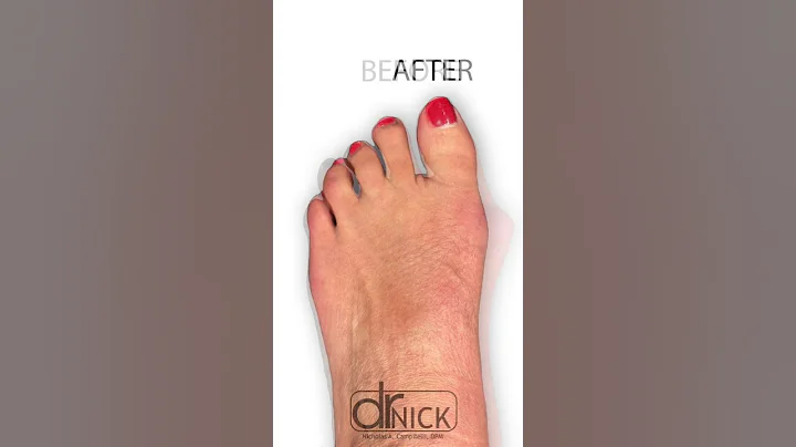 Minimally Invasive Bunion Surgery #shorts