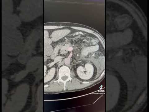 Pancreatite aguda na