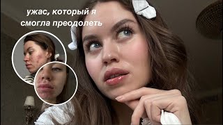 картинка: МОЯ ИСТОРИЯ АКНЕ: прыщи длиною в 12 лет