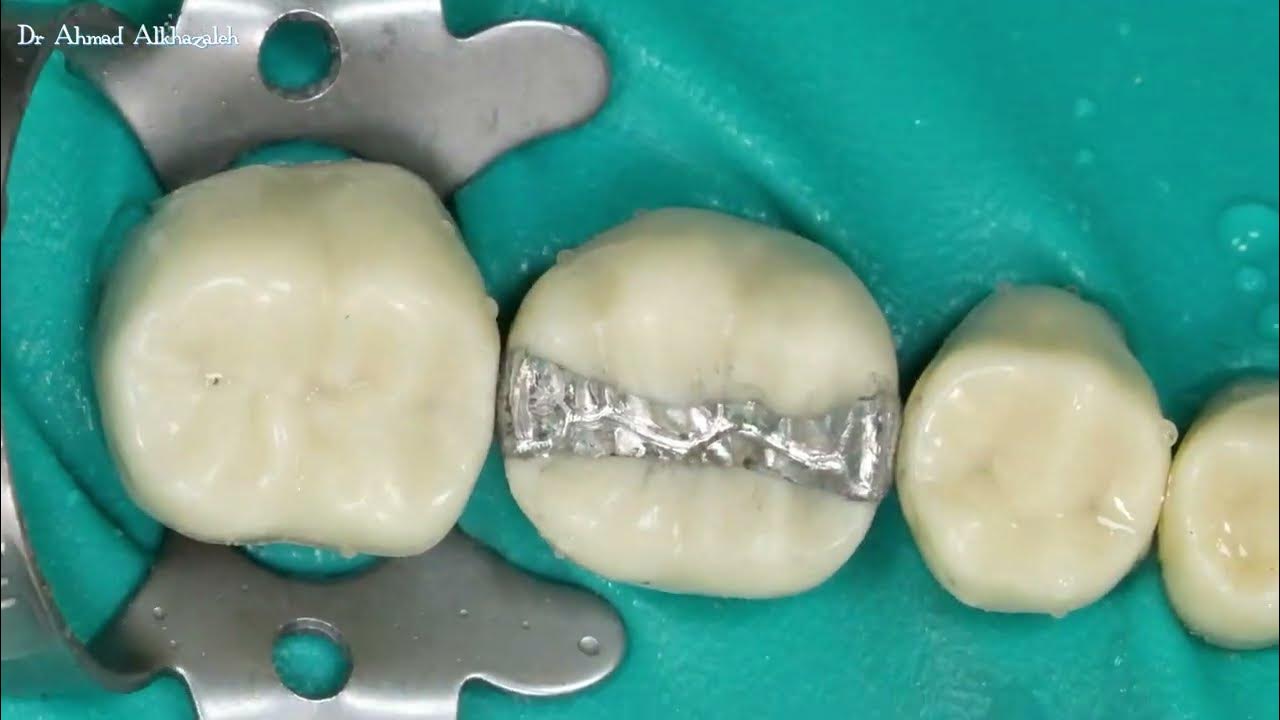 Amalgam restoration polishing steps YouTube