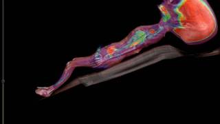Ambivu Alien PETCT.avi
