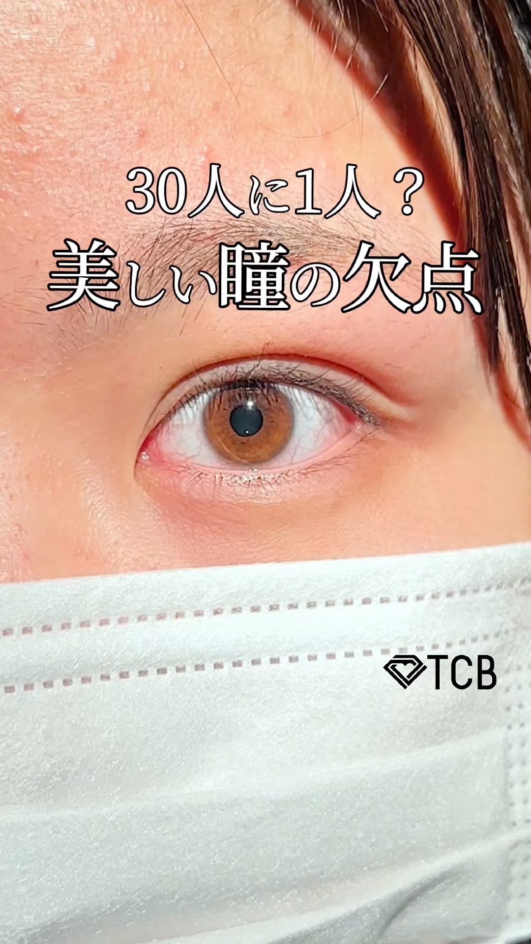 EYE eyelid surgery セレクト美容塾　眼瞼　まぶた　希少 maxresdefault.jpg
