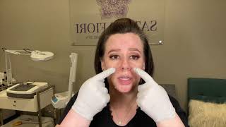 Performing a chemical peel on myself with Ultra Peel 1 PCA Skin