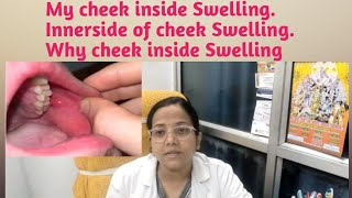 My cheek inside Swelling.Innerside of cheek Swelling,Why cheek inside Swelling.insideCheek swelling