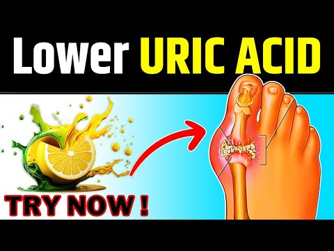 Lower URIC ACID Naturally | Karma Ayurveda | Kidney Expert USA | Kidney Treatment in Ayurveda