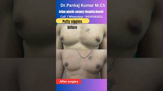 Puffy S - After Surgery Best Treatment Of Puffy S Puffy S Treatment In Ranchi