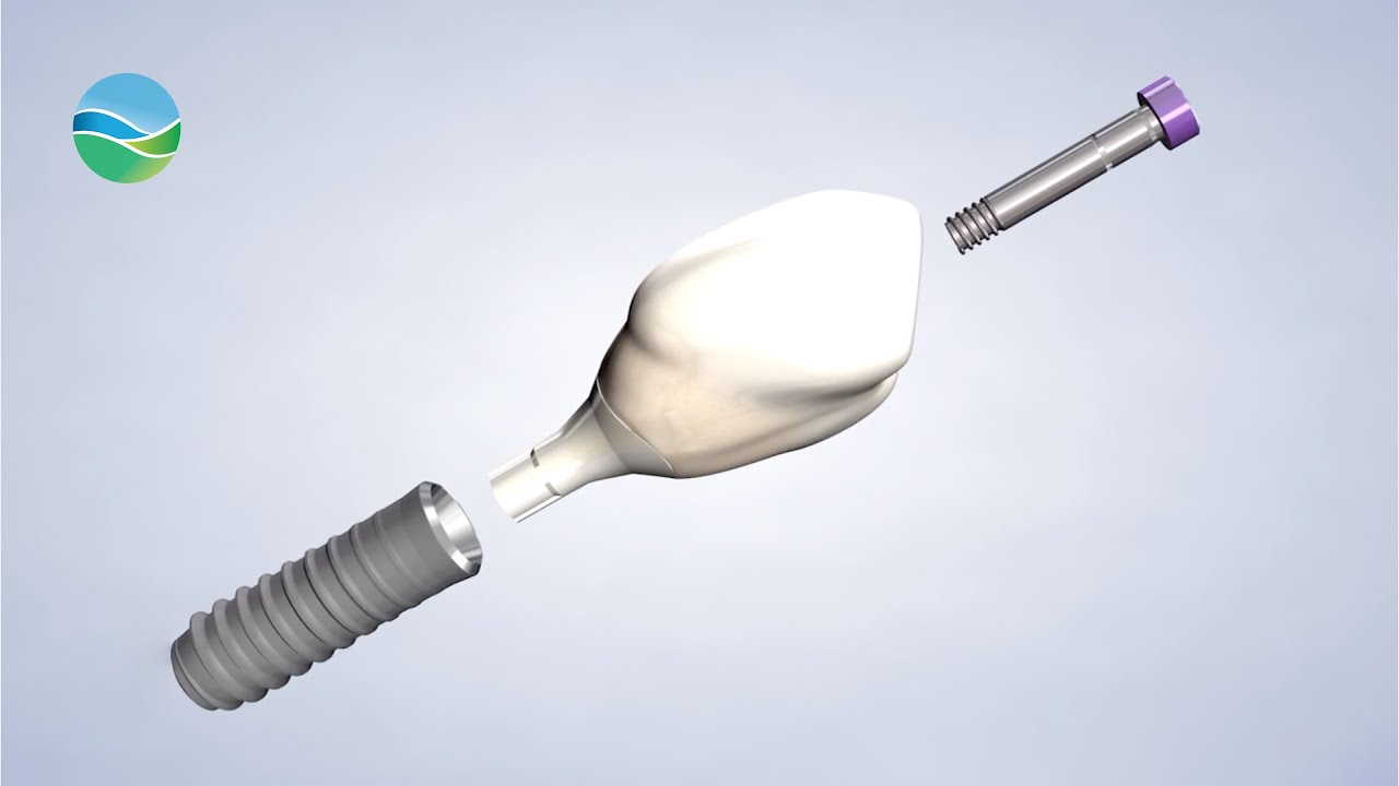 What are Dental Implants at Southern Oral & Facial Surgery in Franklin