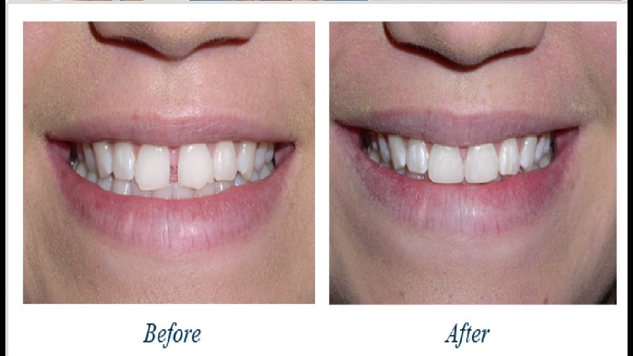 how to get rid of gap between front teeth without braces ...