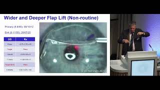 Forefront Refractive Surgery Course, Day 2, Lecture 8:  Lifetime Treatment Planning