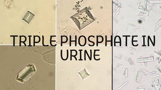 Triple Phosphate Crystal In Urineunder 40X Microscope