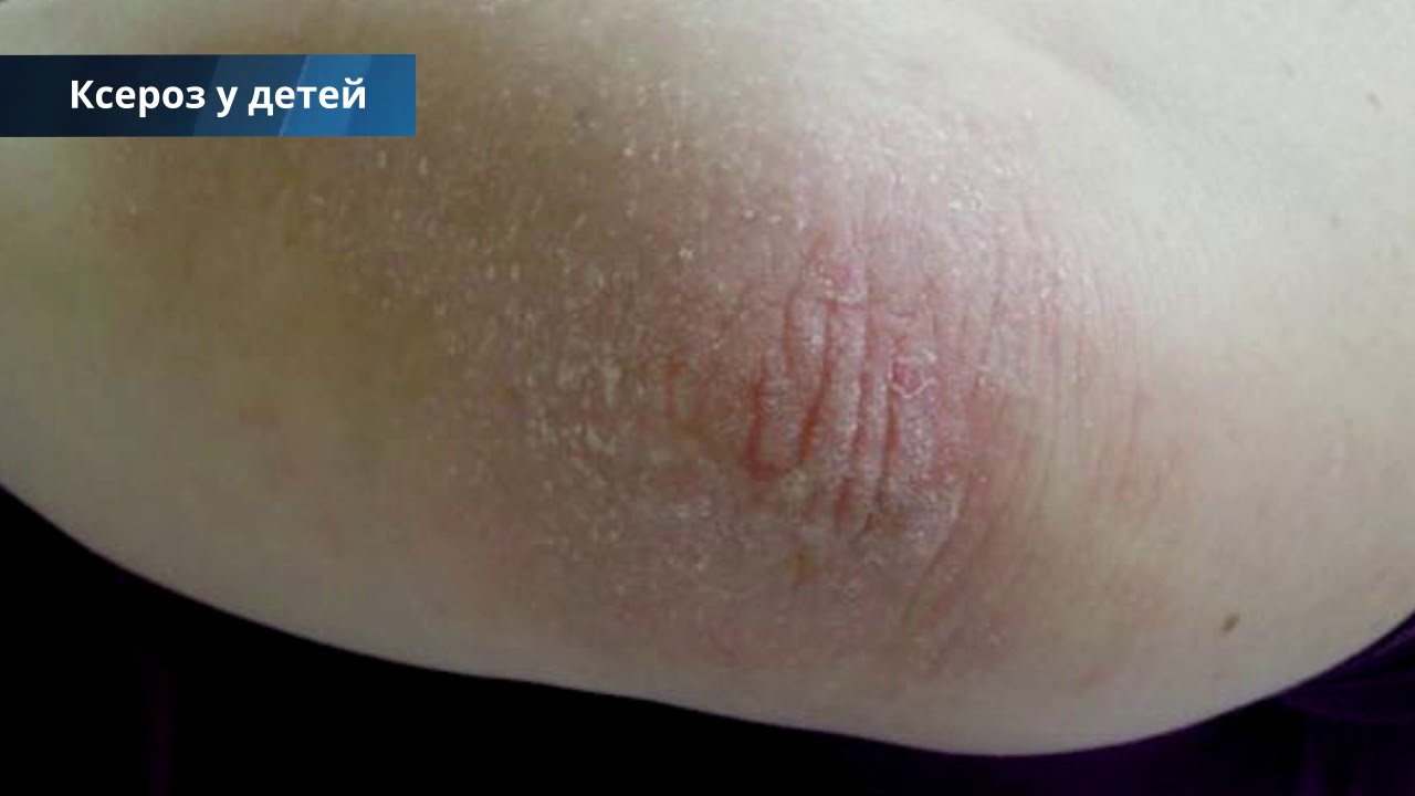 Как лечить Ксероз кожи - фото, причины, симптомы заболевания, народные ...