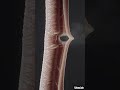 Athlete Killer - Achilles Tendon Tear