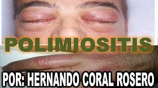 Causa crucigrama debilidad muscular que de enfermedad