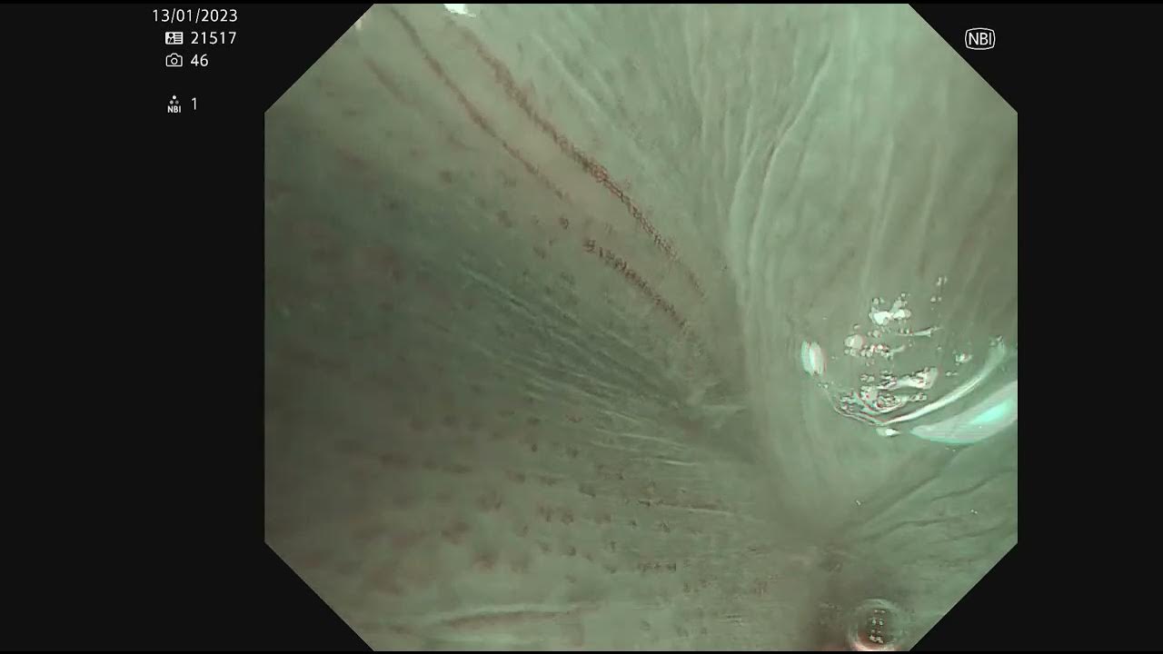 Magnification endoscopy intrapapillary capillary loops (IPCLs) YouTube