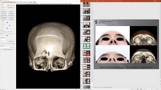남자이마성형 이마 안와상융기(눈썹뼈) 보형물 수술 (실리콘 이마보형물제거)