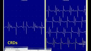 Complex repetitive discharges, CRDs