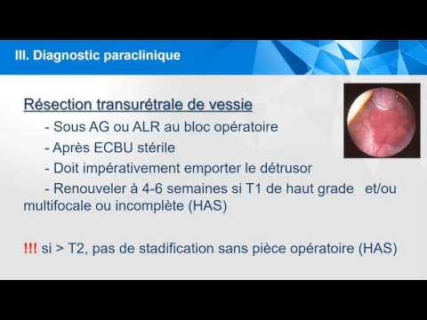 Vidéo: Innocuité Et Efficacité De La Résection Transurétrale En Bloc Par Rapport à La Résection Transurétrale Conventionnelle Pour Le Cancer Primitif Non Invasif De La Vessie: Une Méta-an