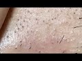 【Plucking facial hair】ずっと見ていられる従然のヒゲ抜き 2024.8.30(頬ヒゲ抜き)【Pull out the beard】