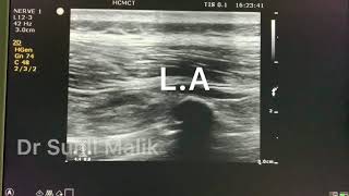 USG Erector Spinae Plain block (ESP)