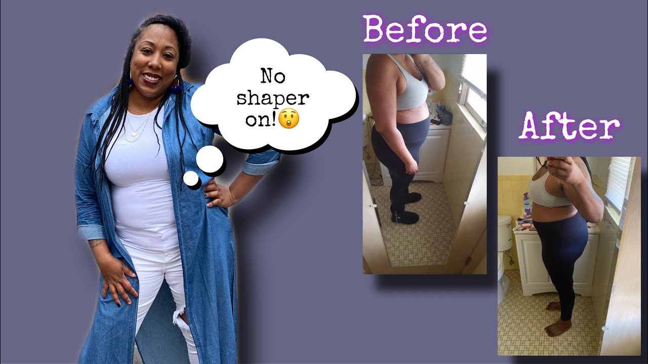 Smart Lipo With Sono Bello Before And After Pics Youtube