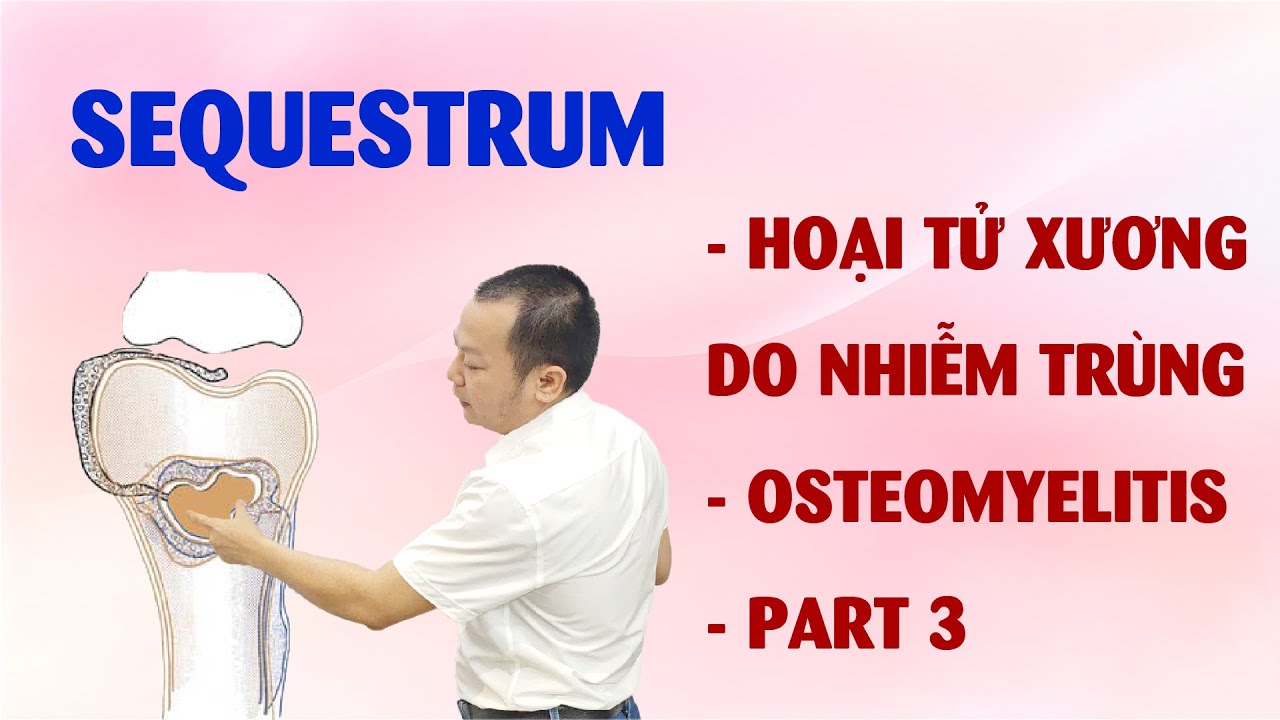 Sequestrum- Hoại Tử Xương Do Nhiễm Trùng - Osteomyelitis - Part 3 - YouTube
