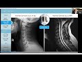 X Ray versus MRI of the Spine