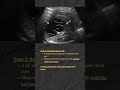 Complex Renal Cysts Ultrasound Images #ultrasonography #ultrasoundtraining