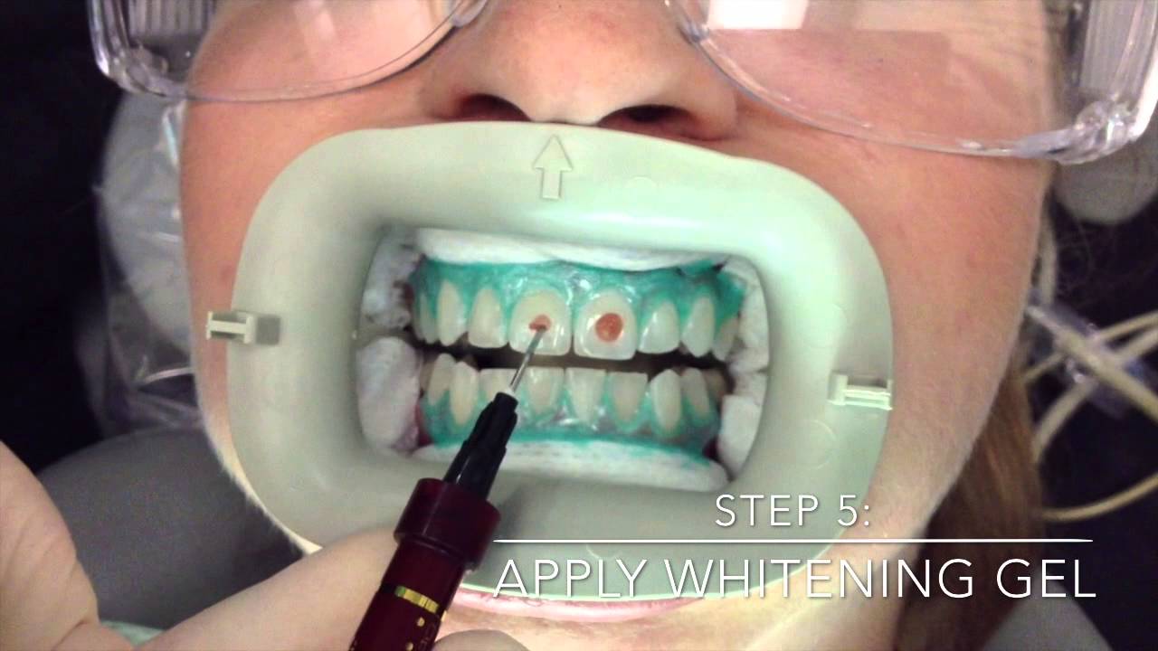Professional In-Office Teeth Whitening by Mint Dental OC ...