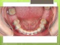 Orthodontics Treatment: Before Dental Implants