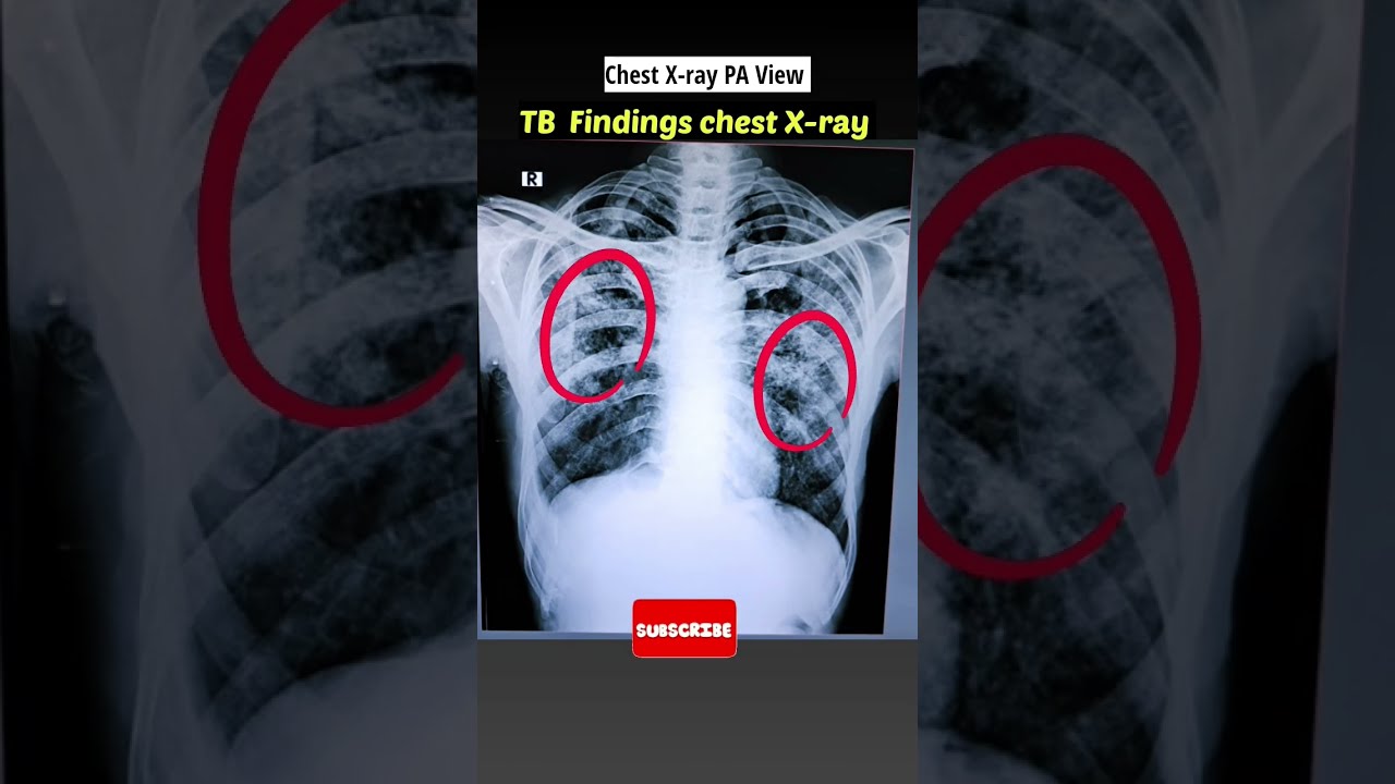 TB Hone Par Chest X Ray Kaisa Dikhta Hai Xray Shorts