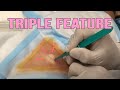 Cyst Triple Feature - More More More