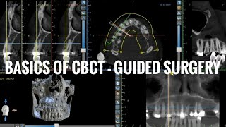 Basics Of CBCT - Guided Surgery Part 1