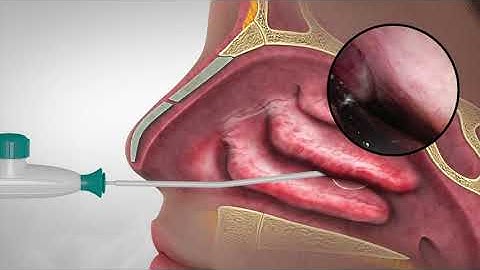 ClariFix to Treat Chronic Runny Nose and Congestion
