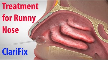 ClariFix to Treat Chronic Runny Nose and Congestion