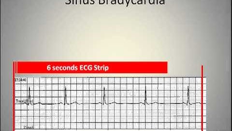 ECG Interpretation Video Lecture 3-A