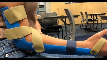 Posterior Elbow Immobilization (Long Arm) Orthosis
