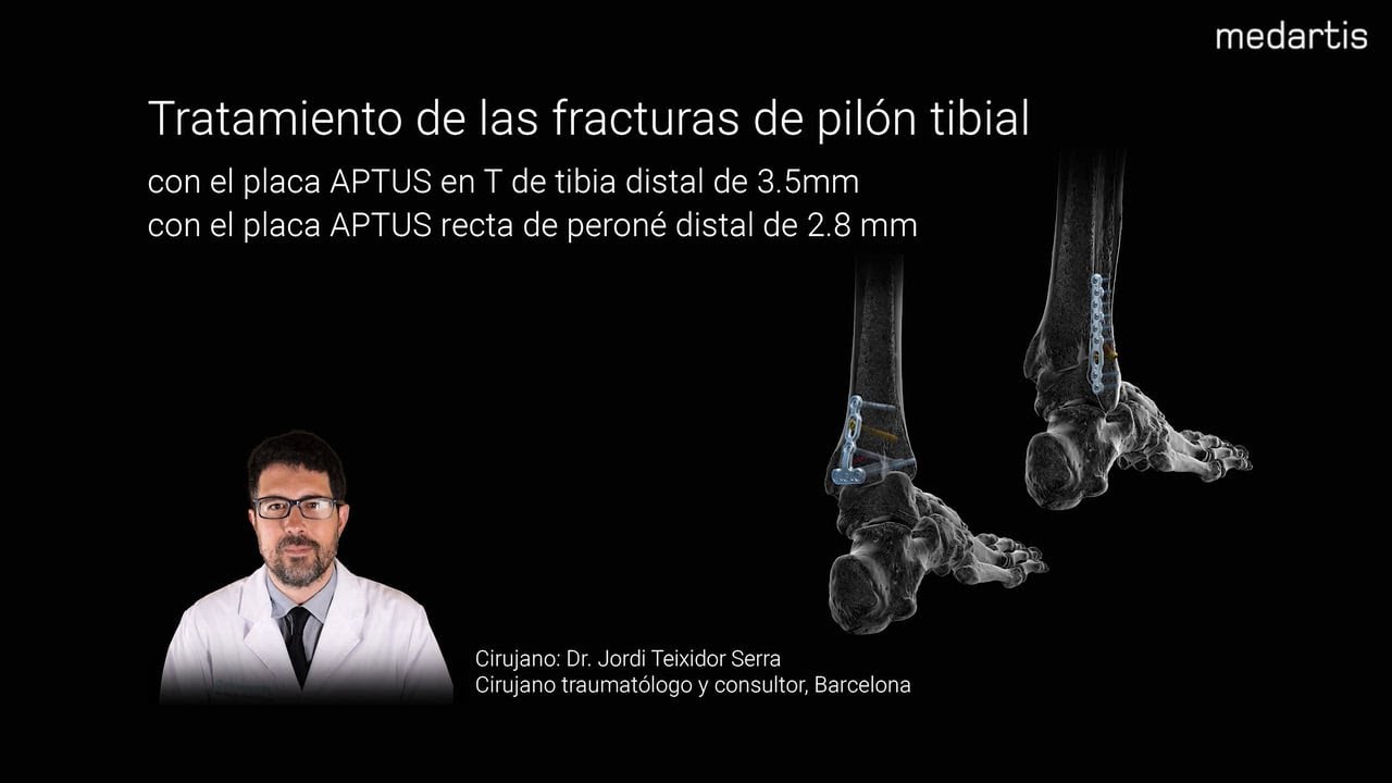 Tratamiento de las fracturas de pilón tibial - YouTube
