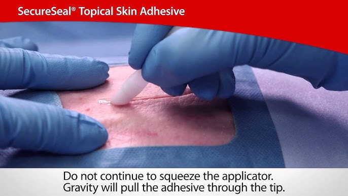 Step-by-Step Guide for Effective Application of DERMABOND PRINEO