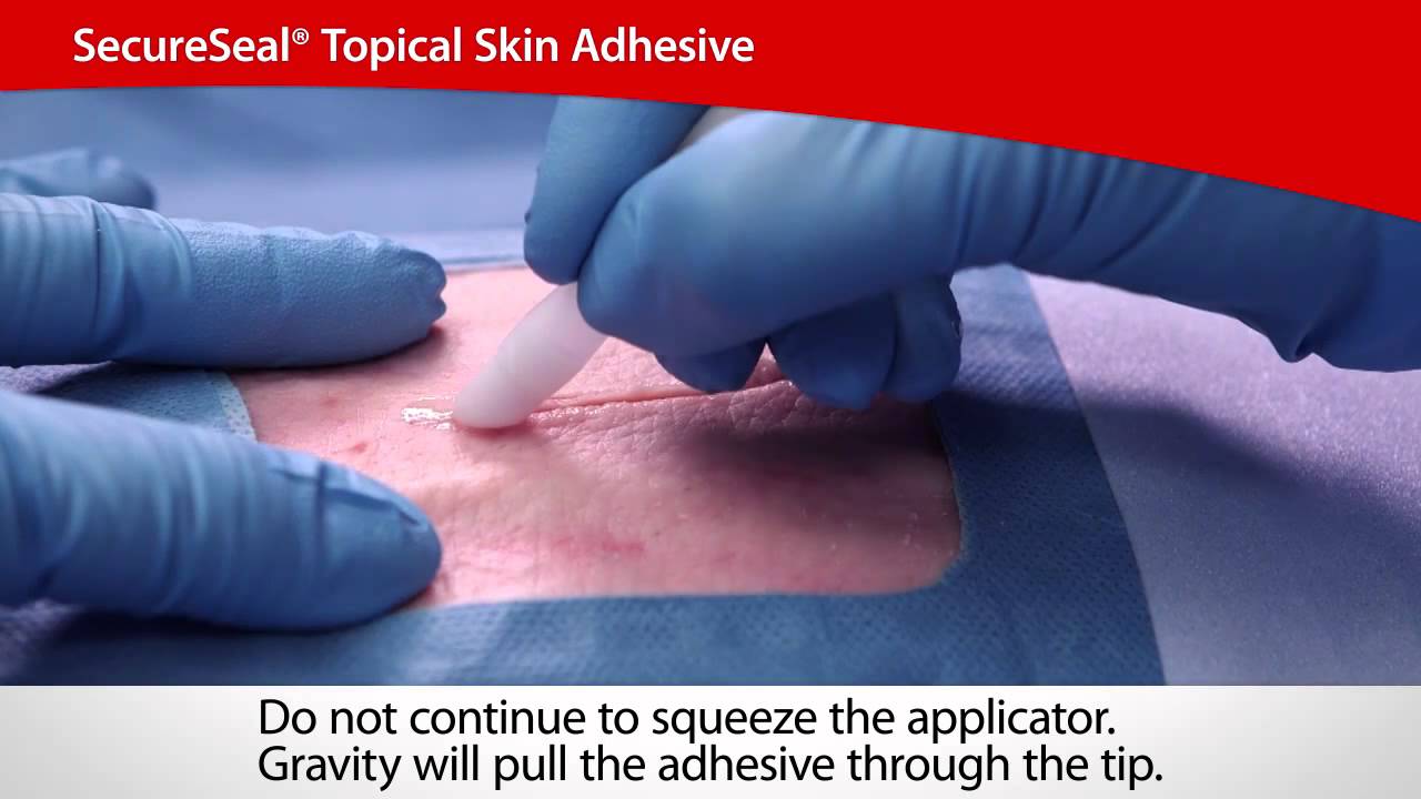 SecureSeal® Topical Skin Adhesive